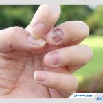 مهم‌ترین عوارض کاشت ناخن که از آن بی‌اطلاع هستید!