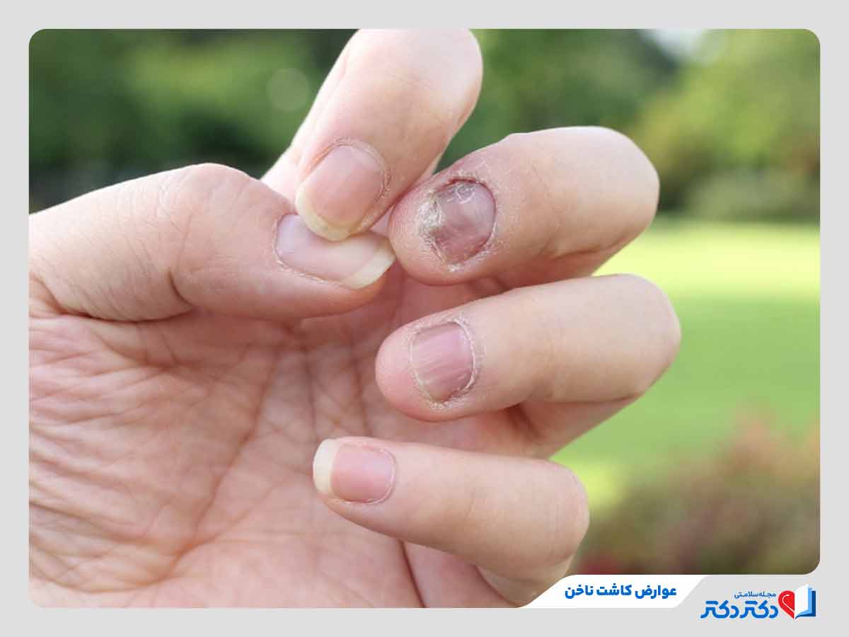 فرد مبتلا به عوارض کاشت ناخن