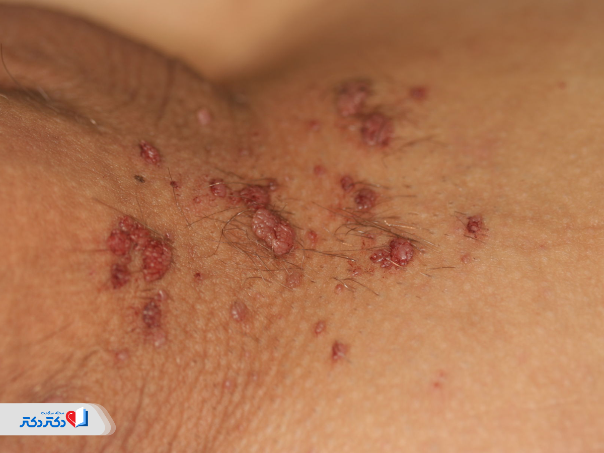 محل تجمع و پراکندگی زائده‌ها از راه‌های تشخیص زگیل تناسلی