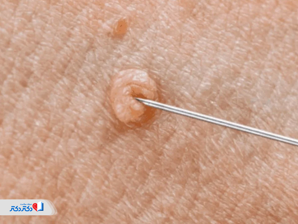 بیوپسی و تشخیص ویروس زگیل تناسلی