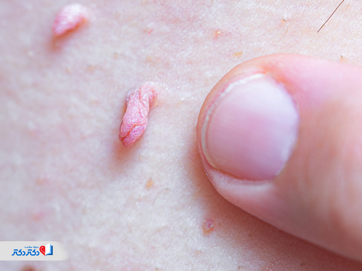 راه‌های تشخیص زگیل تناسلی + hpv از زبان پزشک