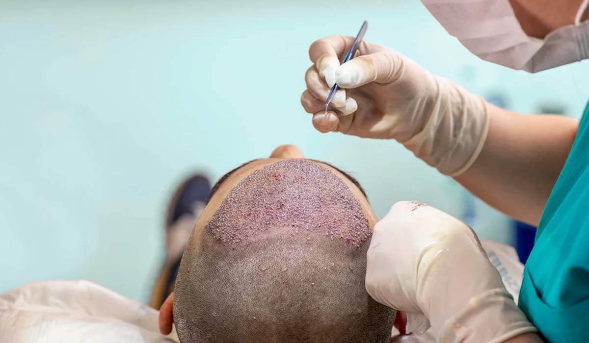 عمل کاشت مو طبیعی گسترده‌تر برای مردان
