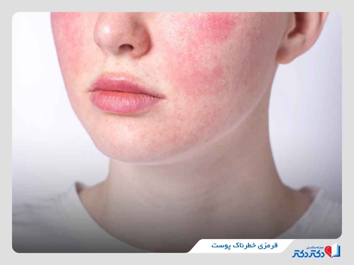قرمزی خطرناک پوست صورت