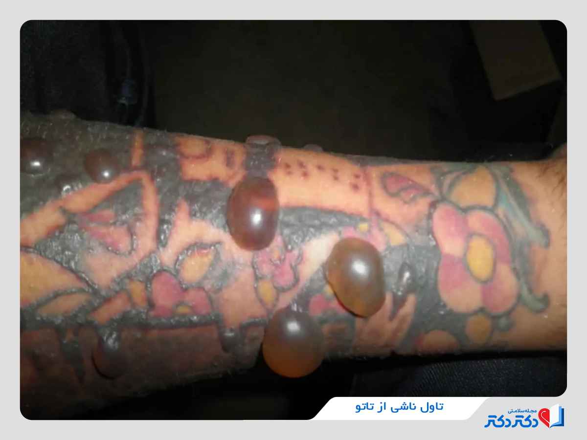 عوارض ناخوشایند تتو