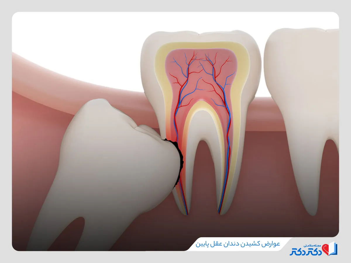 عوارض کشیدن دندان عقل پایین و بالا