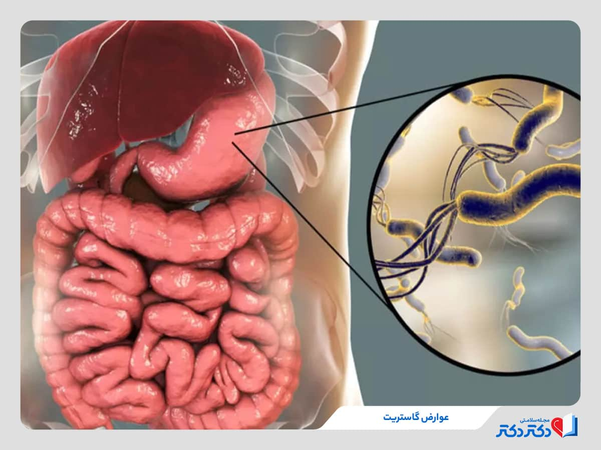 ورم معده یا گاستریت