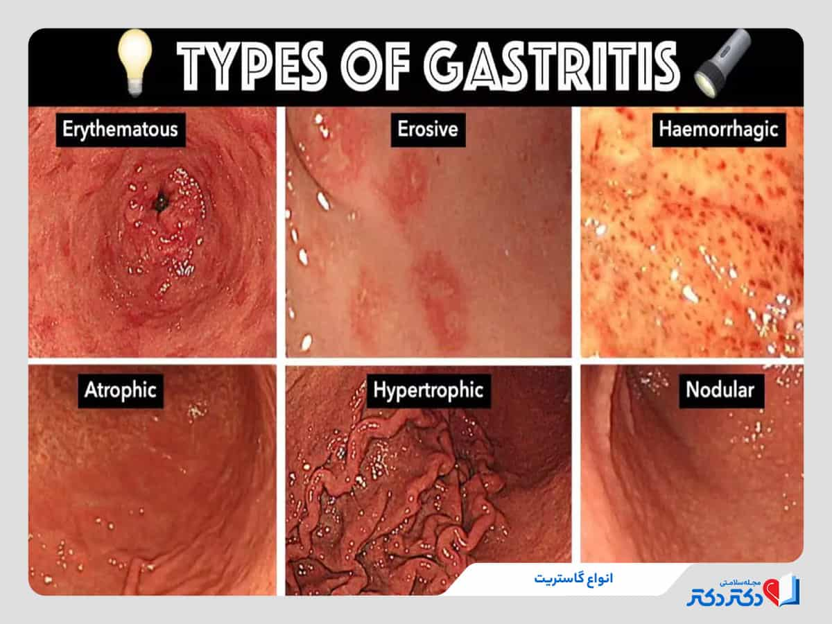 انواع گاستریت معده