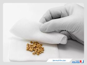 درمان سنگ صفرا؛ جراحی کیسه صفرا بهتر است یا دفع سنگ؟