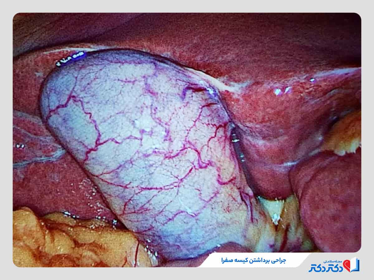 عمل جراحی سنگ کیسه صفرا