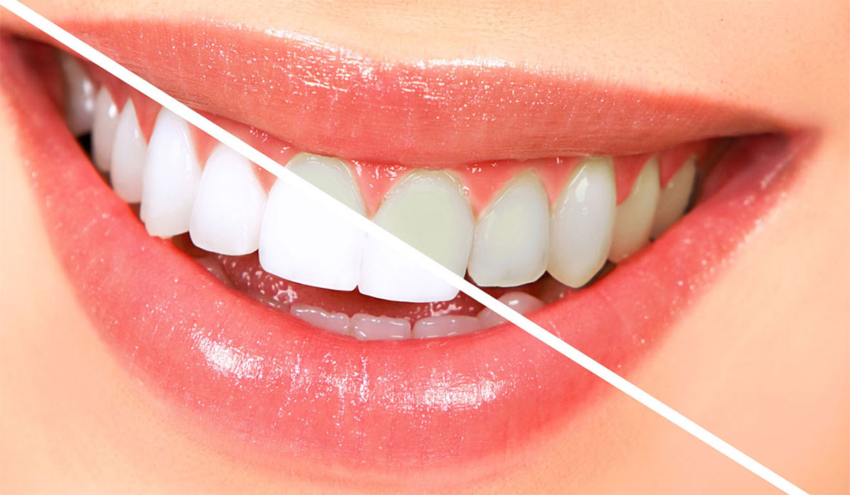 جلوگیری از زرد شدن دندان