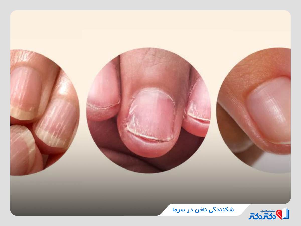 شکنندگی ناخن در سرما