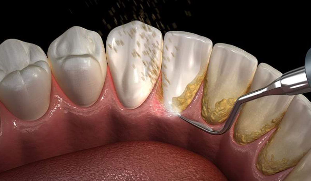 مراحل جرم‌گیری دندان