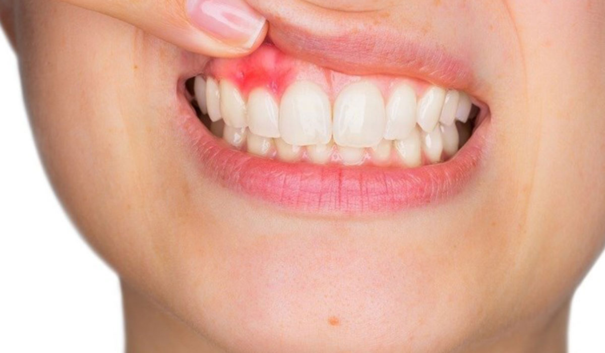 خونریزی بعد از جرم‌گیری دندان