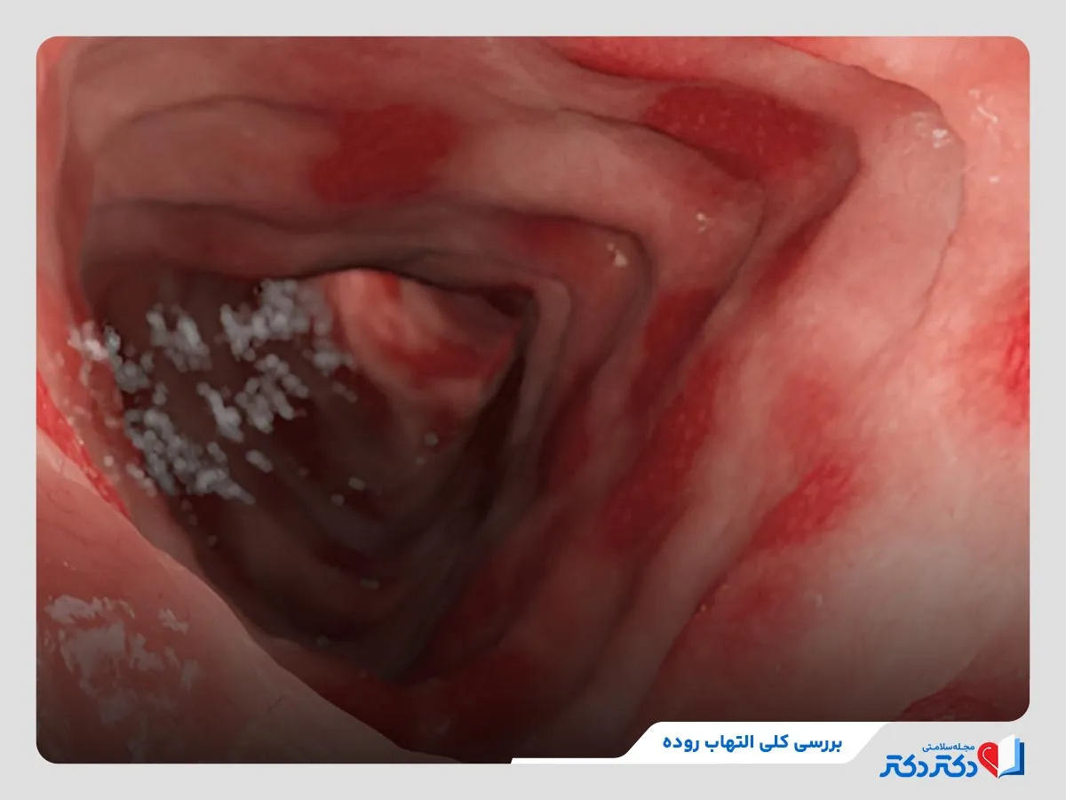 تعریف و بررسی کلی التهاب روده