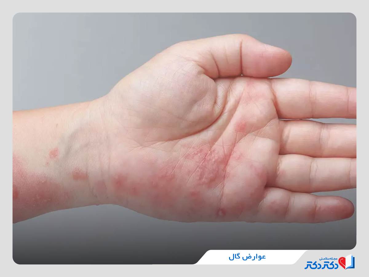 عوارض بیماری گال