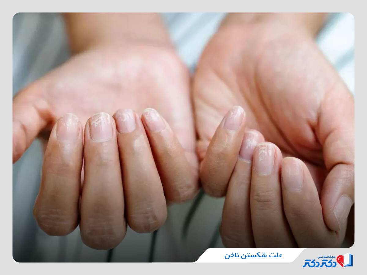 علت شکستن ناخن