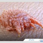 بیماری گال چیست و از چی به‌وجود میاد؟