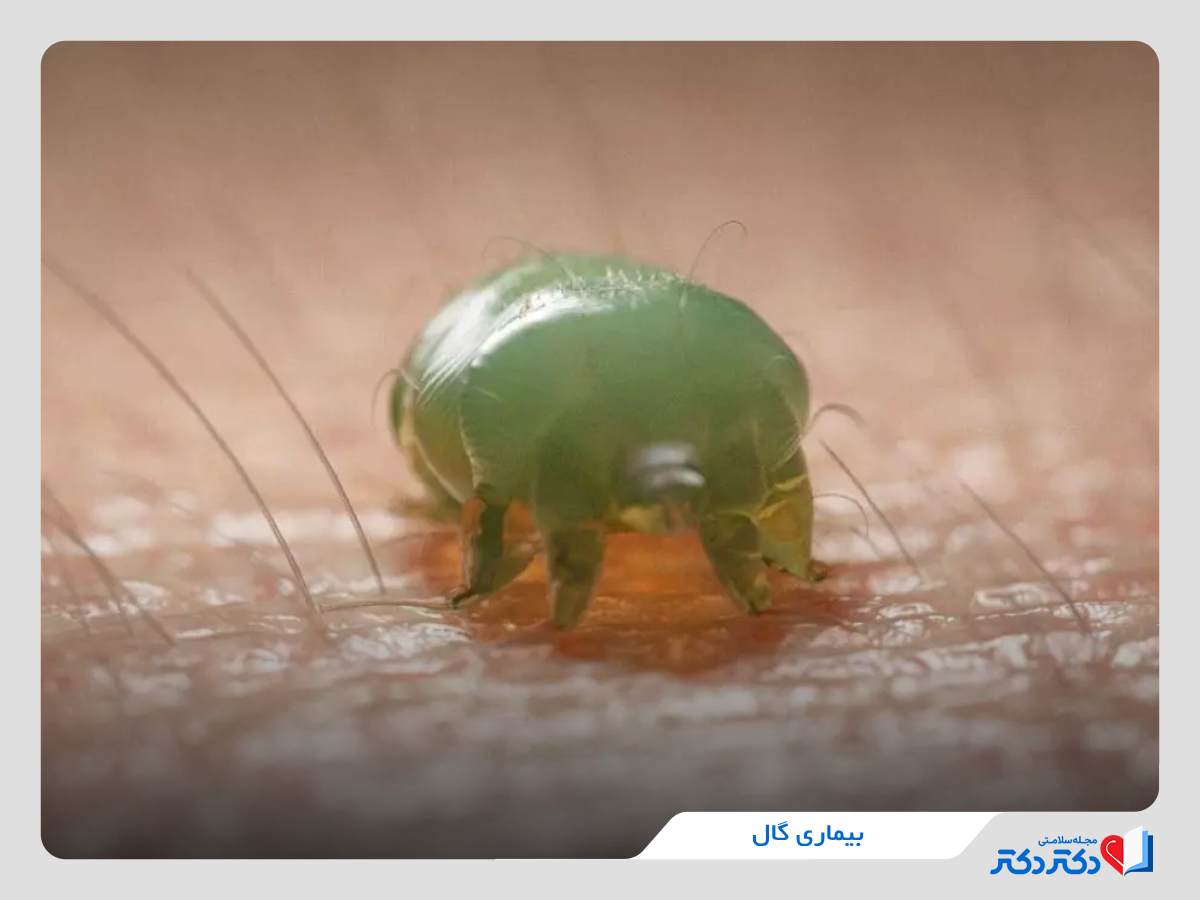 بیماری گال