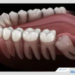 دندان عقل چیست؟ راهنمای کامل دندان عقل و بهترین زمان کشیدن آن