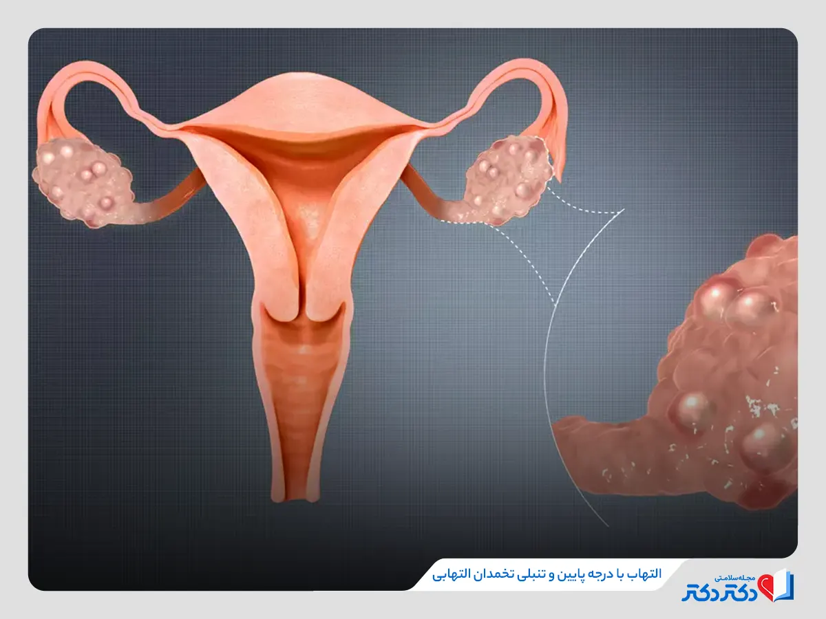 ایجاد التهاب در تخمدان عامل بروز سندروم تنبلی تخمدان 