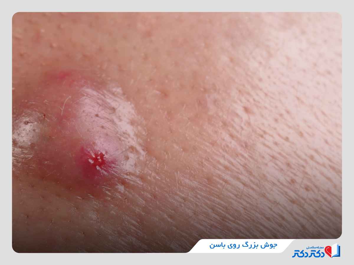 جوش بزرگ روی باسن