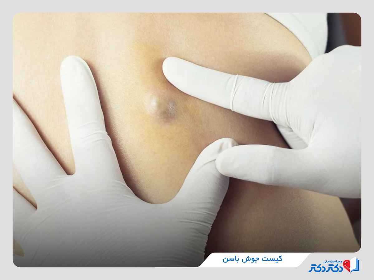 جوش کیست روی باسن