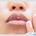 علت خشکی لب چیست و چطور می‌توان آن را درمان کرد؟