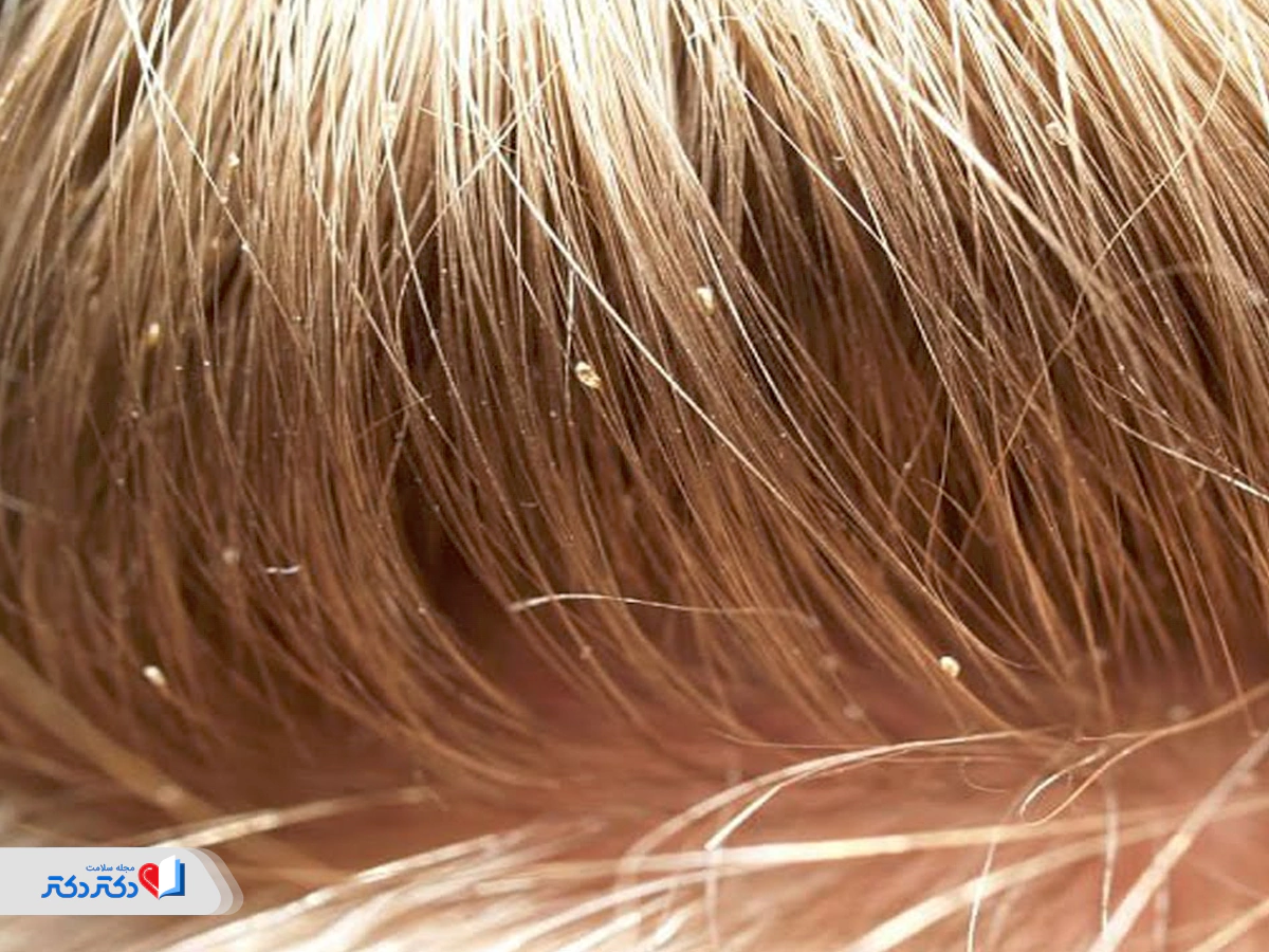 تصویر رشک روی موی سر
