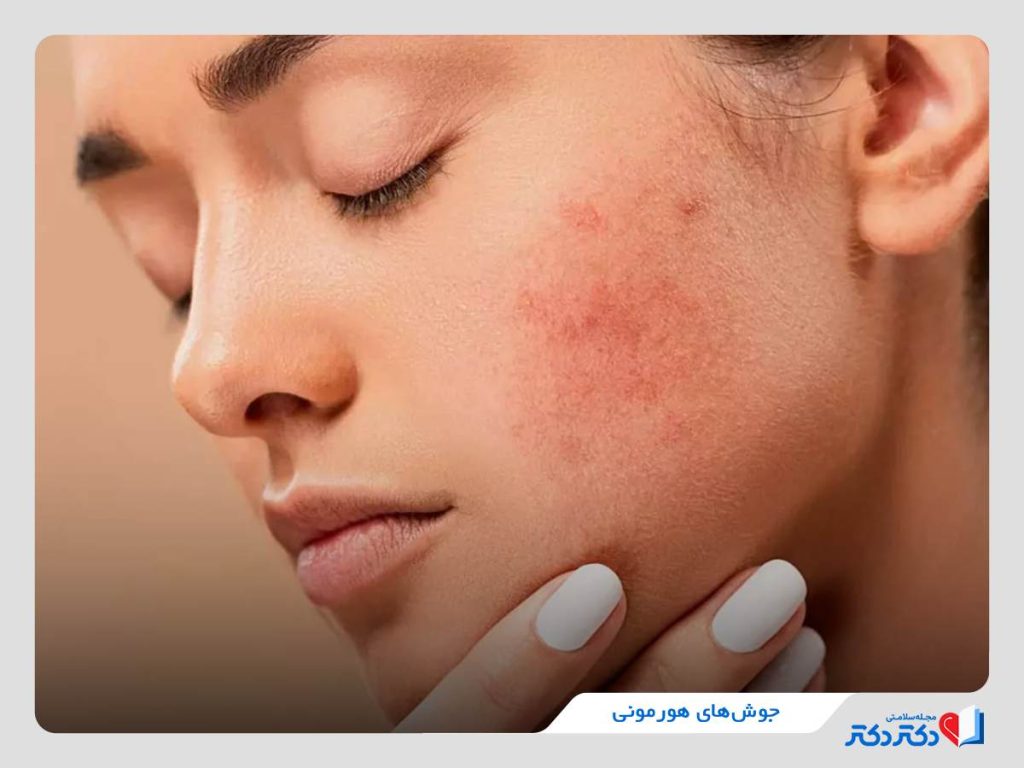 جوش‌های هورمونی
