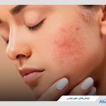 چطور جوش‌های هورمونی را درمان کنیم؟