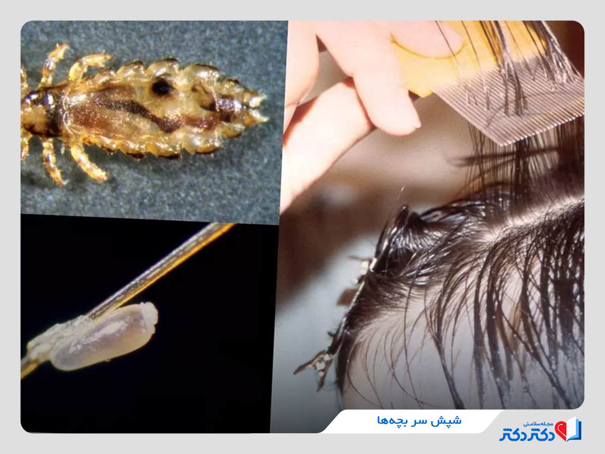 شپش موی سر کودکان