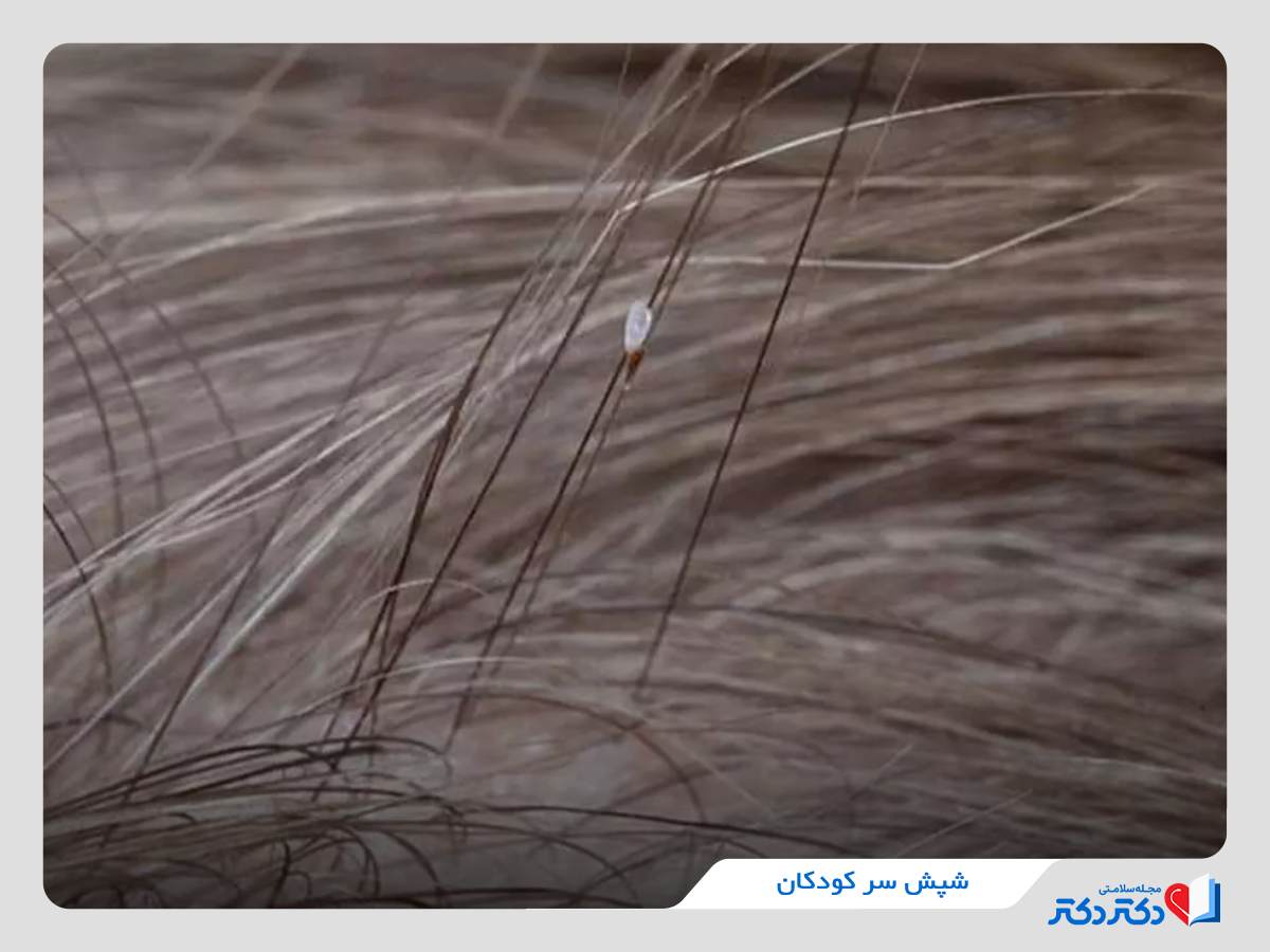 شپش سر کودکان