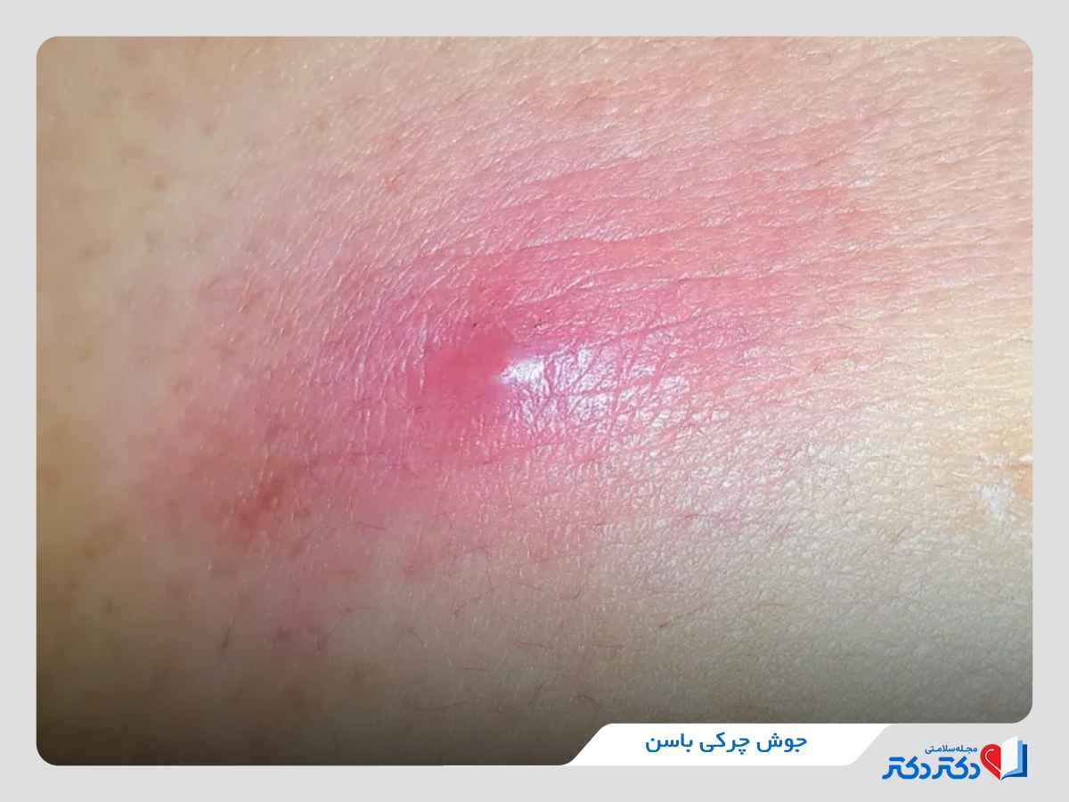جوش چرکی روی باسن