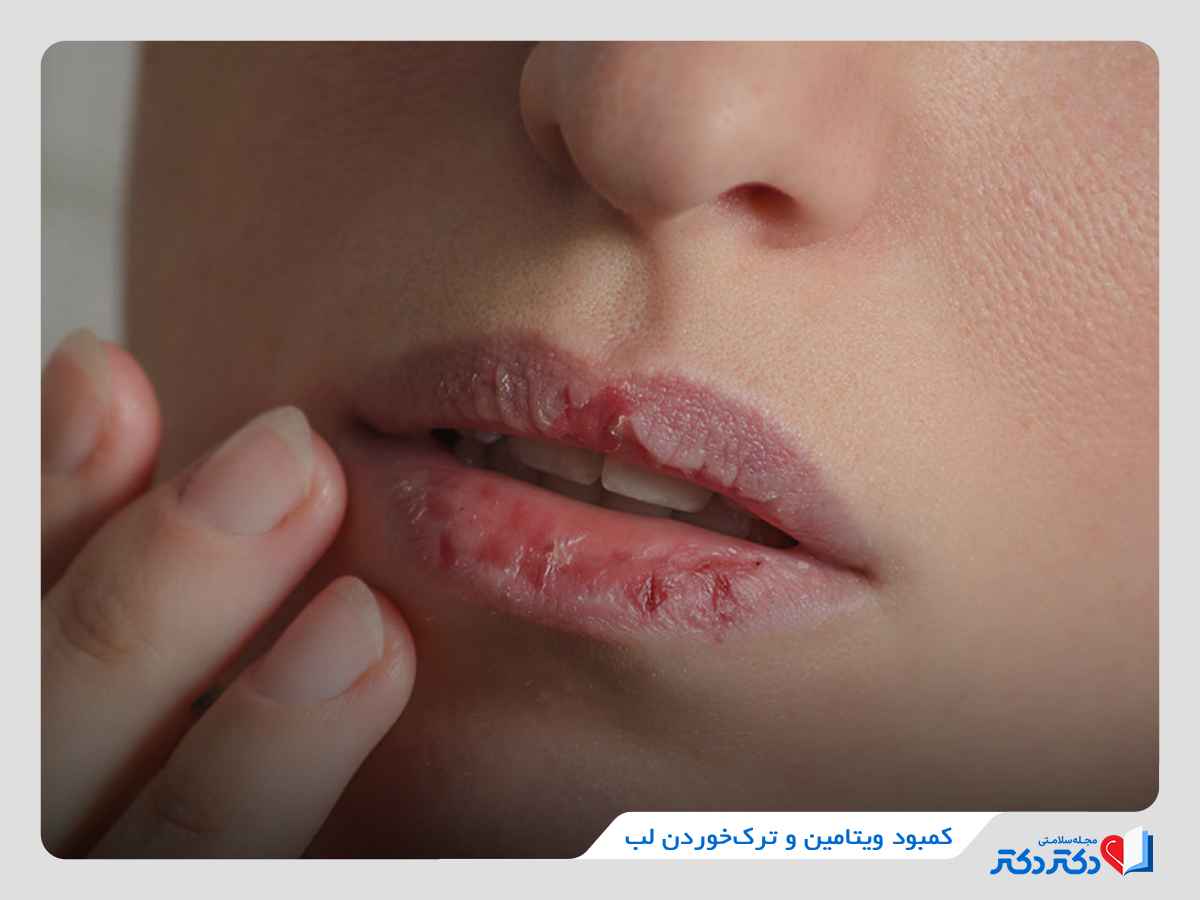 کمبود ویتامین و ترک‌خوردن لب