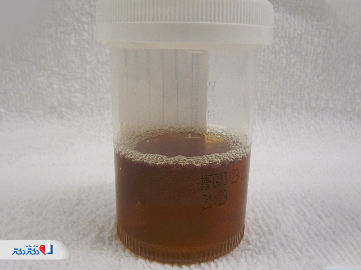 ادرار تیره از عوارض رانیتیدین (Ranitidine)