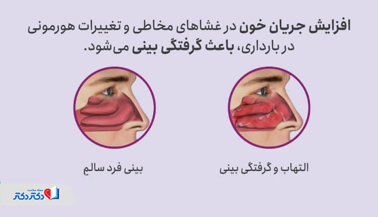 گرفتگی بینی در بارداری ناشی از افزایش چریان خون