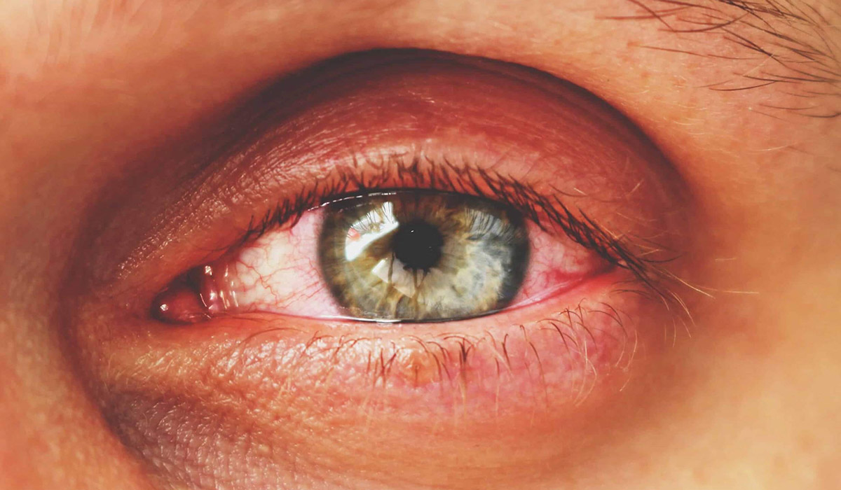 بیماری‌های چشمی