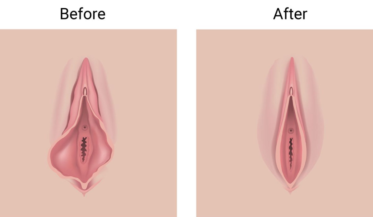 تغییرات واژن بعد از لابیاپلاستی