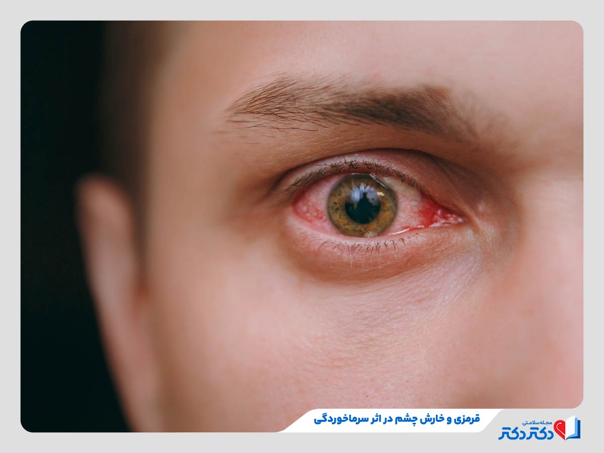 فرد مبتلا به قرمزی و آبریزش در اثر سرماخوردگی چشم