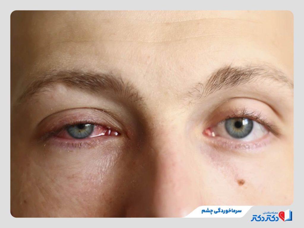 فرد مبتلا به سرماخوردگی چشم