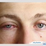 سرماخوردگی چشم چیست و چگونه درمان می‌شود؟
