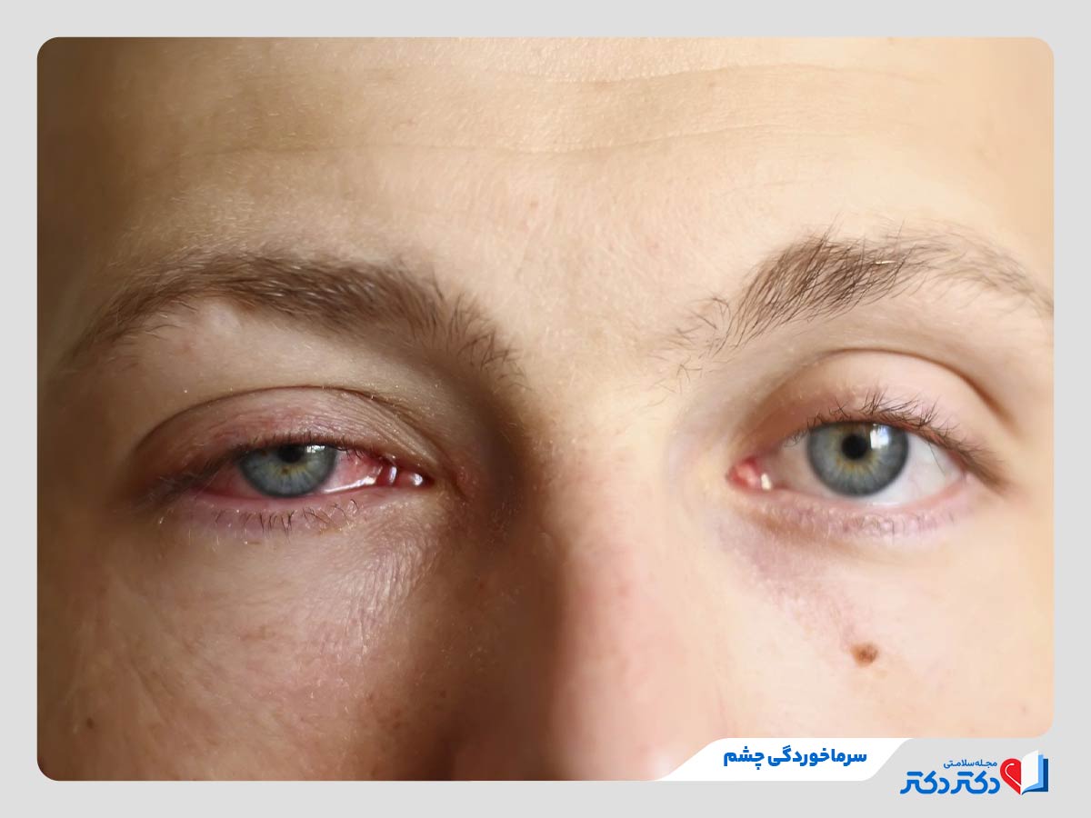 فرد مبتلا به سرماخوردگی چشم