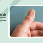 پسوریازیس ناخن چگونه تشخیص داده می‌شود و آیا درمان دارد؟