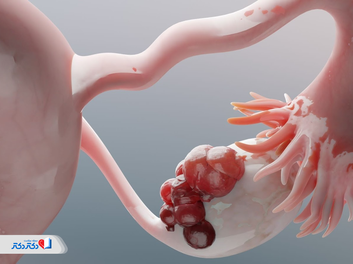 کیست تخمدان از دلایل درد لگن در بارداری