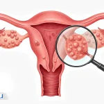کیست تخمدان چیست؟ بررسی کامل علائم، علتها و روشهای درمان