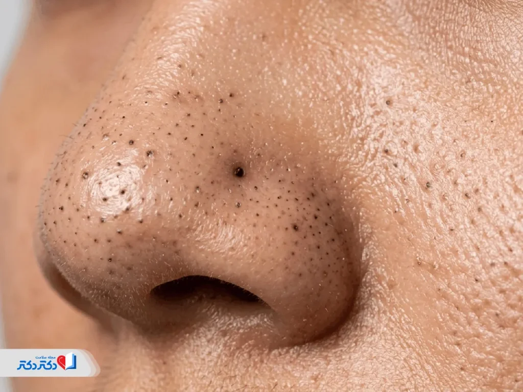 عکس جوش سرسیاه صورت