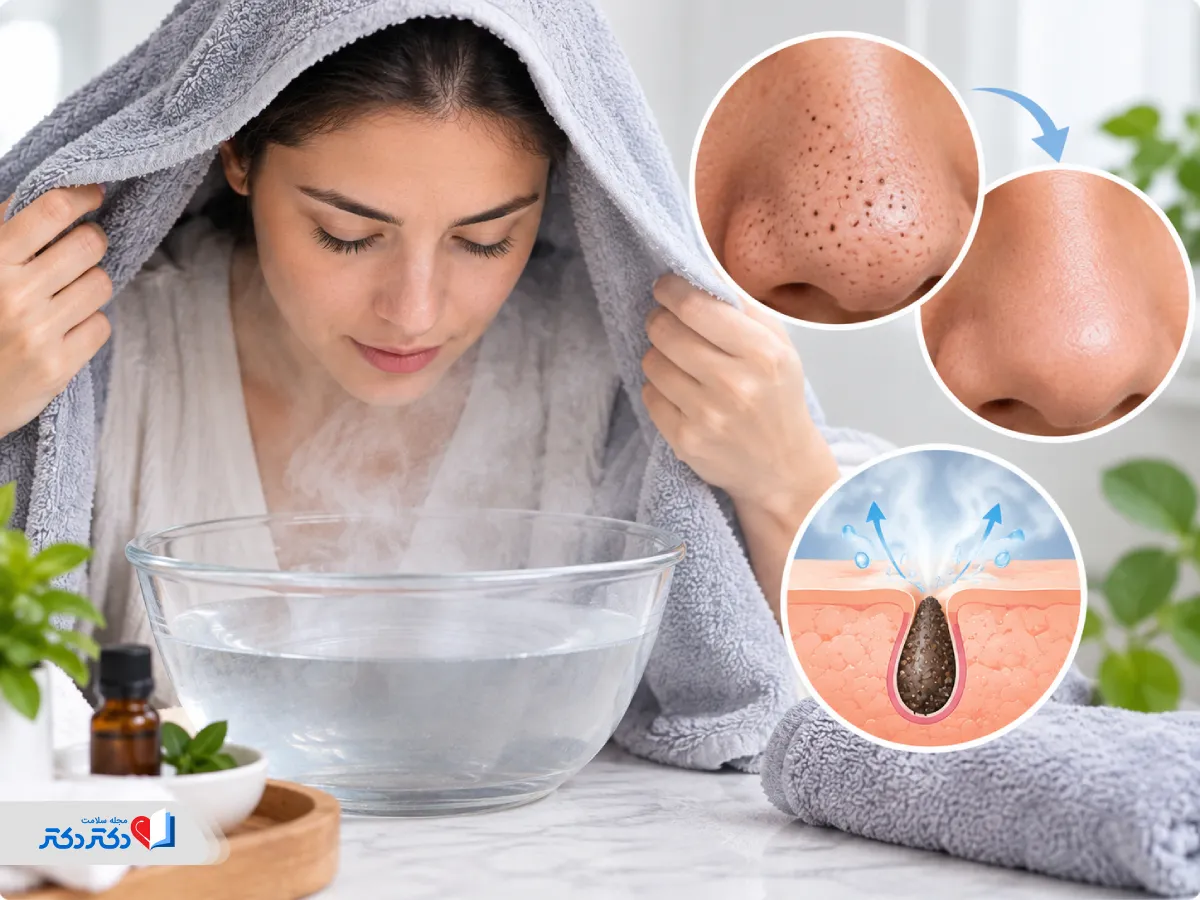 بخور برای جوش سر سیاه