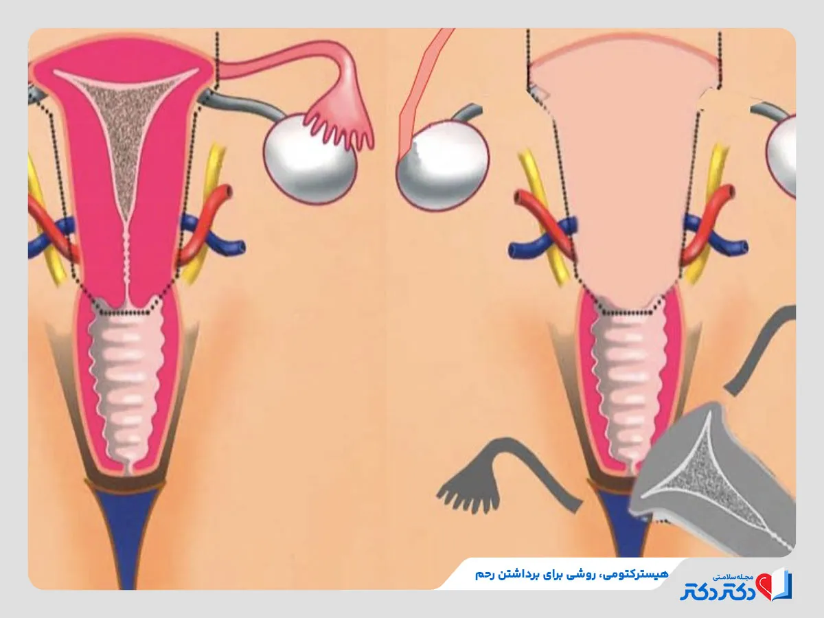 برداشتن رحم از خدمات دکتر زنان