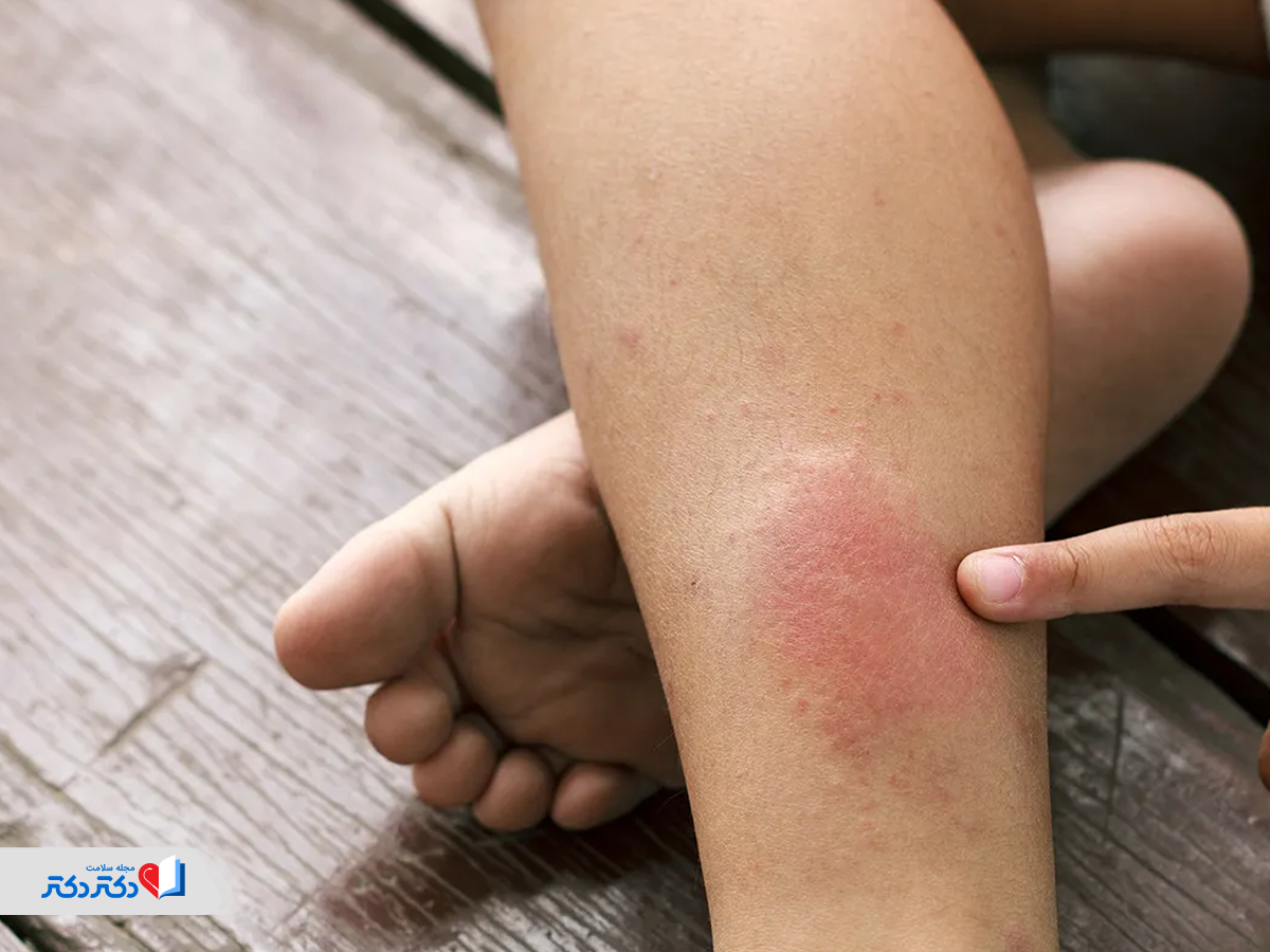 لختگی خون براثر مصرف قرص ضدبارداری