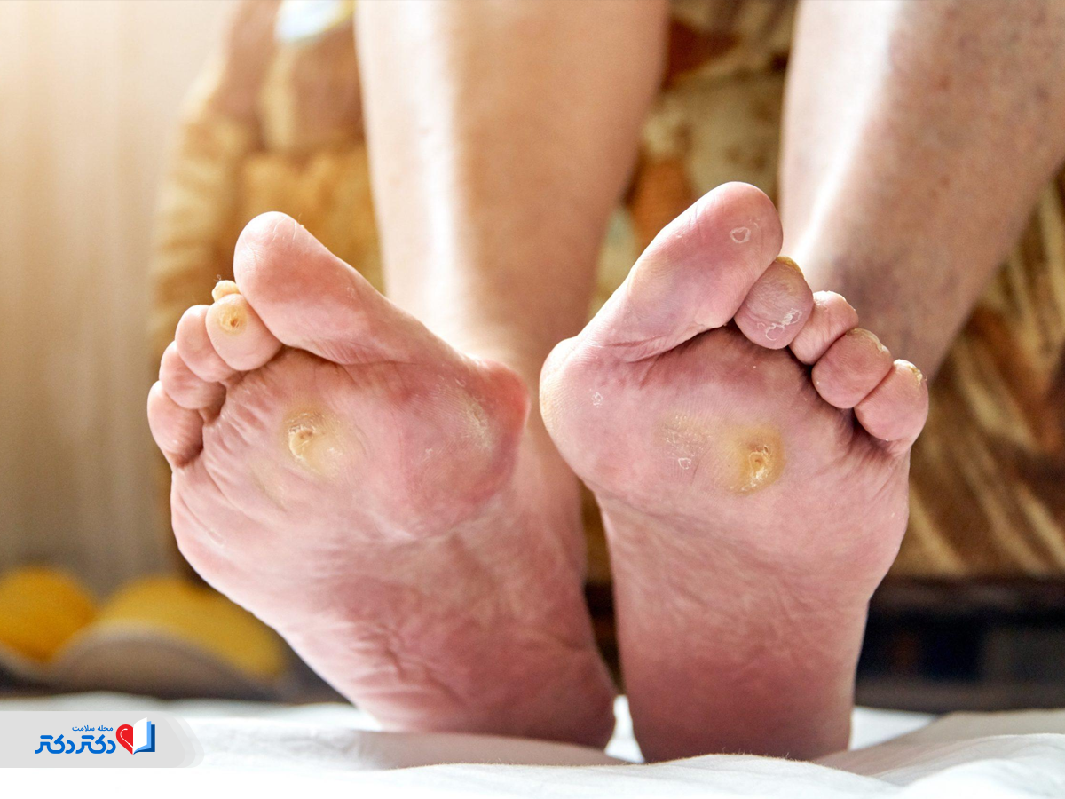 عکس دیابت؛ زخم دیابتی پا